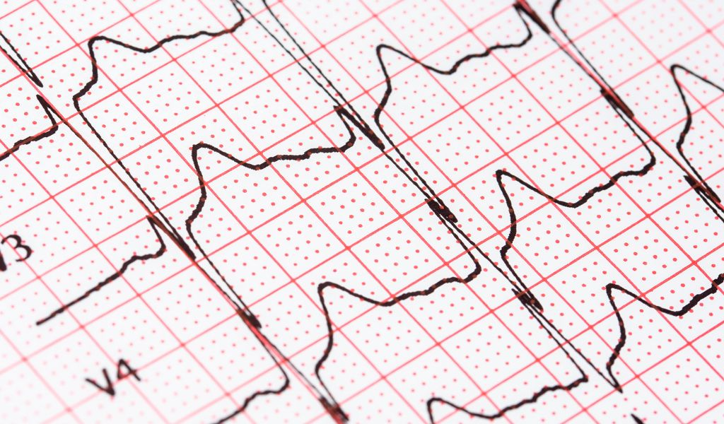 Fibrilação atrial sem palpitações: o risco invisível de AVC