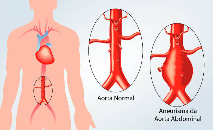 Aneurisma da aorta abdominal: o exame silencioso que o Doppler pode encontrar